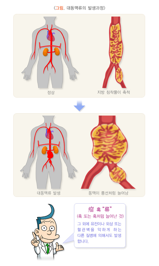 대동맥류의 발생과정