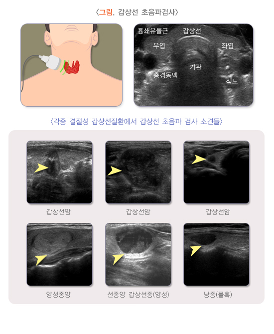 갑상선암 유두암 경과관찰 4개월째 위드심의원 갑상선 초음파 반전결과 리뷰