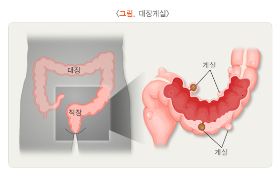 대장게실증 | 국가건강정보포털 | 질병관리청