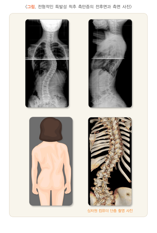 전형적인 특발성 척추 측만증의 전후면과 측면 사진