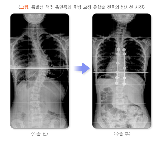 특발성 척추 측만증의 후방 교정 유합술 전후의 방사선 사진