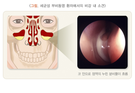 세균성 부비동염 환자에서의 비강 내 소견