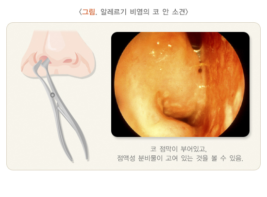 알레르기 비염의 코 안 소견