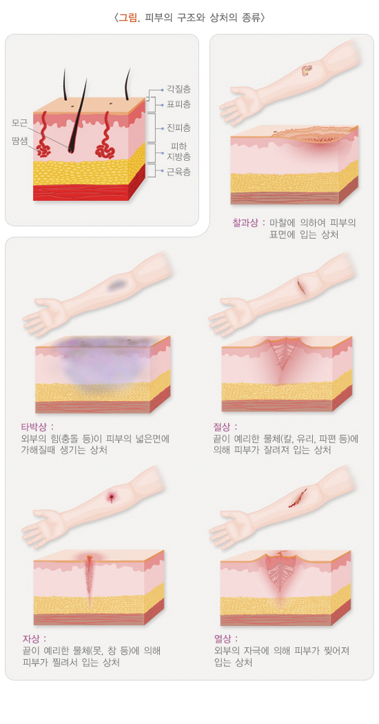 피부의 구조와 상처의 종류
