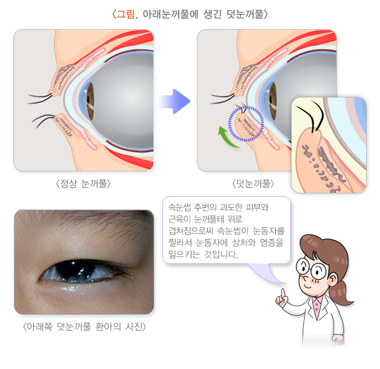 아래눈꺼풀에 생긴 덧눈꺼풀