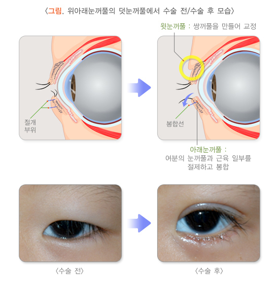 위아래눈꺼풀의 덧눈꺼풀에서 수술 전/수술 후 모습