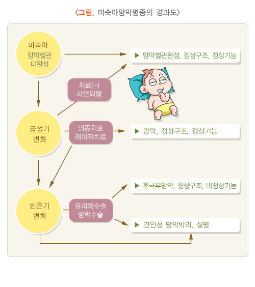 미숙아망막병증의 경과도