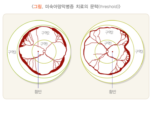 미숙아망막병증 치료의 문턱(threshold)