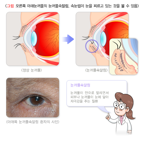 우안의 아래눈꺼풀 눈꺼풀겉말림