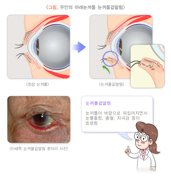 오른쪽 아래눈꺼풀의 눈꺼풀속말림. 속눈썹이 눈을 찌르고 있는 것을 볼 수 있음