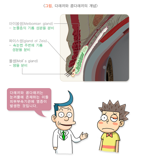 다래끼와 콩다래끼의 개념