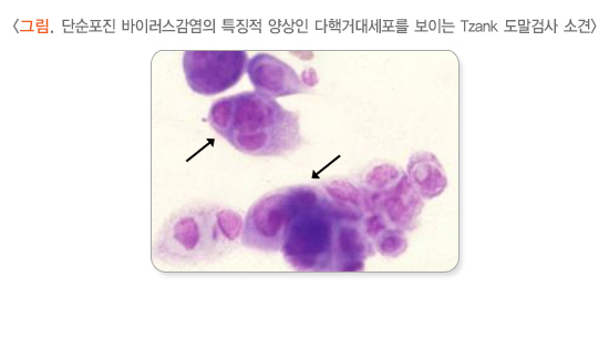 단순포진 바이러스감염의 특징적 양상인 다핵거대세포를 보이는 Tzank 도말검사 소견