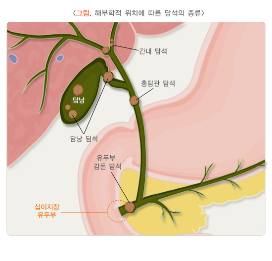 해부학적 위치에 따른 담석의 종류