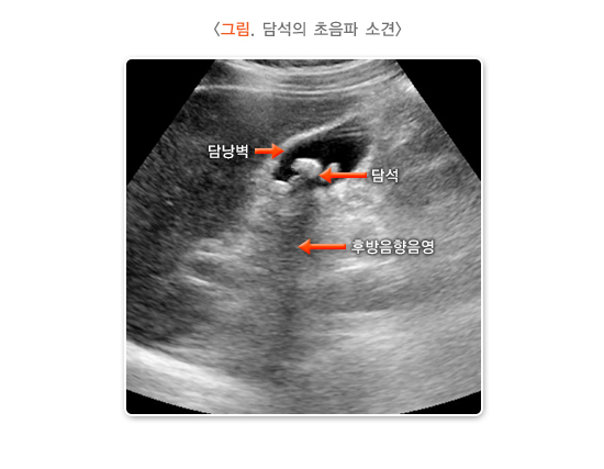 담석의 초음파 소견