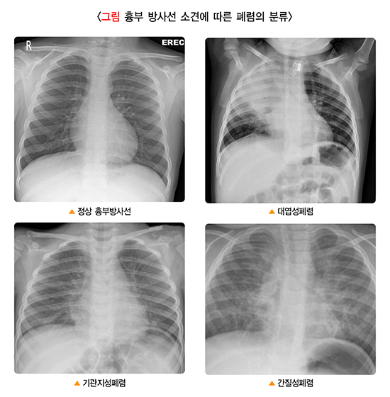 흉부 방사선 소견에 따른 폐렴의 분류