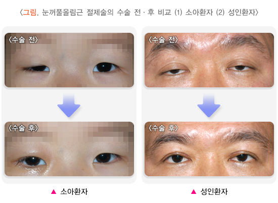 눈꺼풀올림근 절제술의 수술 전 · 후 비교 (1) 소아환자 (2) 성인환자