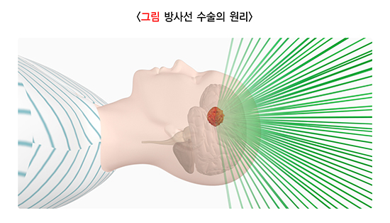 방사선 수술의 원리