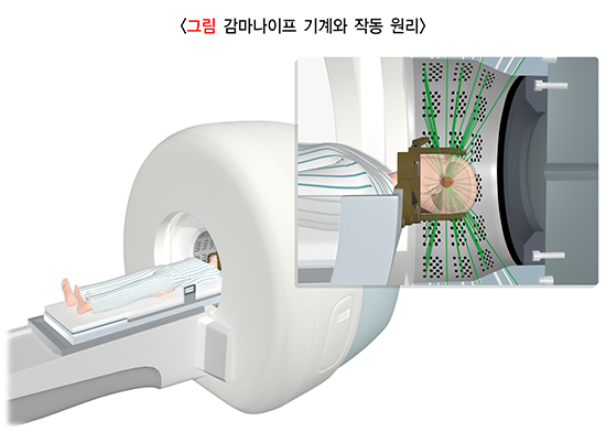 감마나이프 기계와 작동 원리