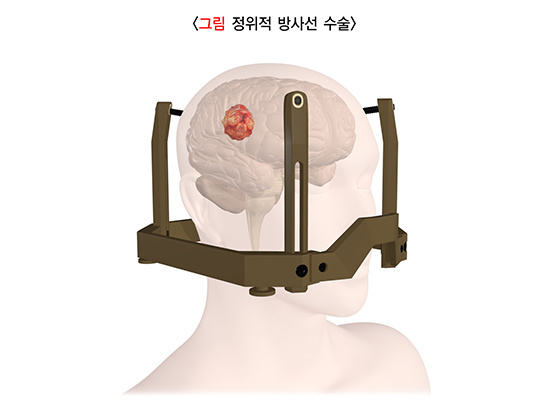 정위적 방사선 수술