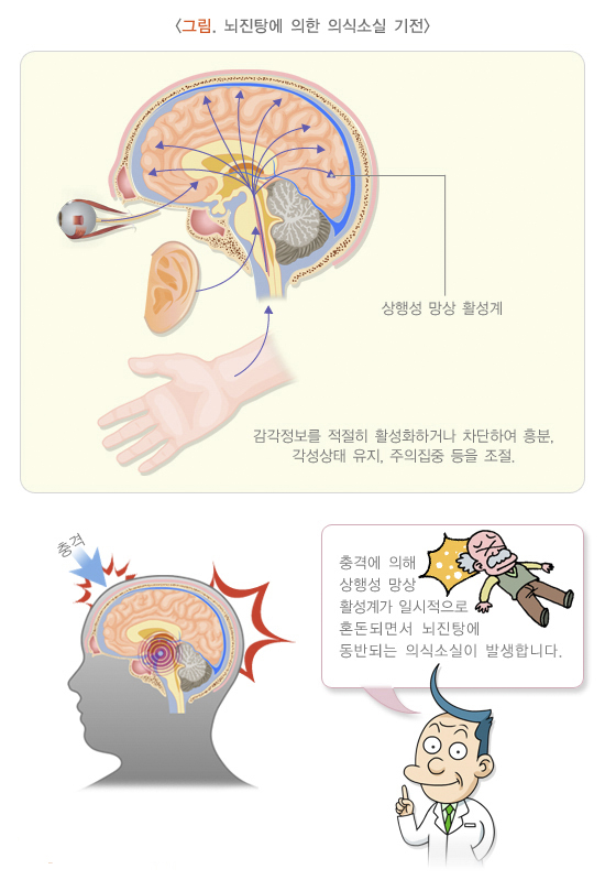 뇌진탕에 의한 의식 소실 기전