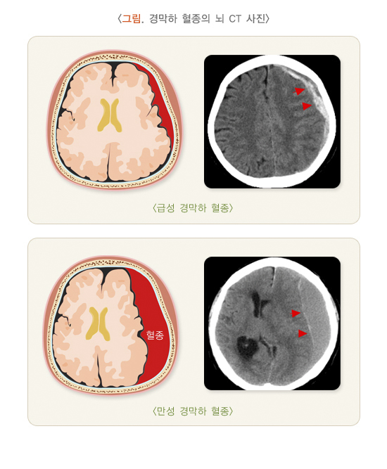 경막하 혈종의 뇌 CT 사진
