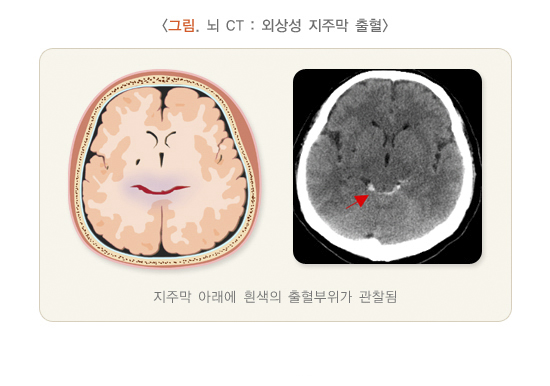 뇌 CT : 외상성 지주막 출혈