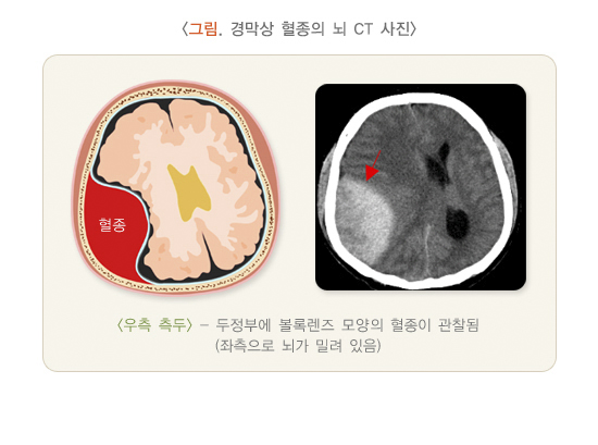 경막상 혈종의 뇌 CT 사진