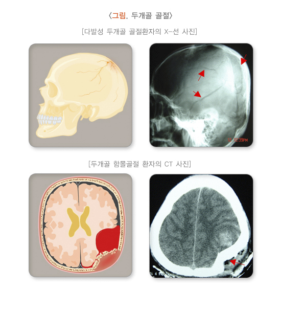 두개골 골절