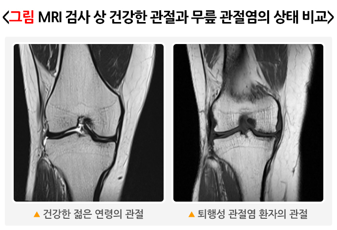 MRI 검사 상 건강한 관절과 무릎 관절염의 상태 비교