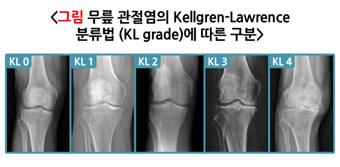 무릎 관절염의 Kellgren-Lawrence 분류법 (KL grade)에 따른 구분