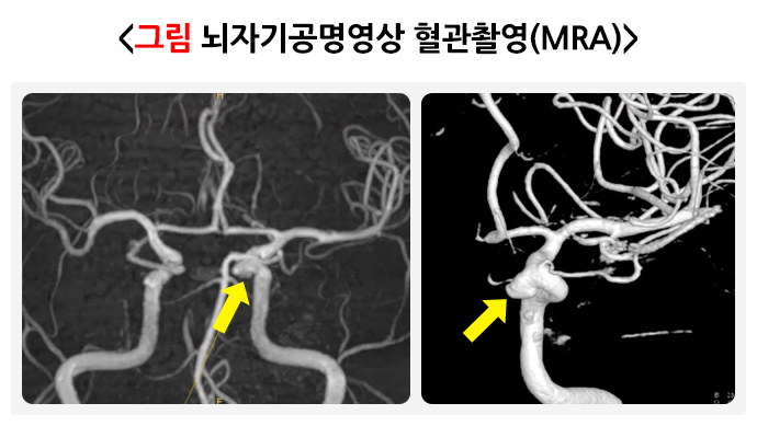 뇌자기공명영상 혈관촬영(MRA)
