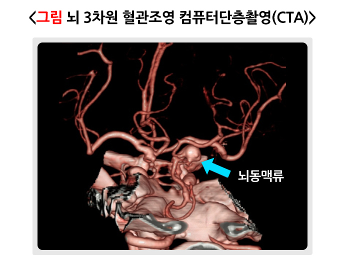 뇌 3차원 혈관조영 컴퓨터단층촬영(CTA)