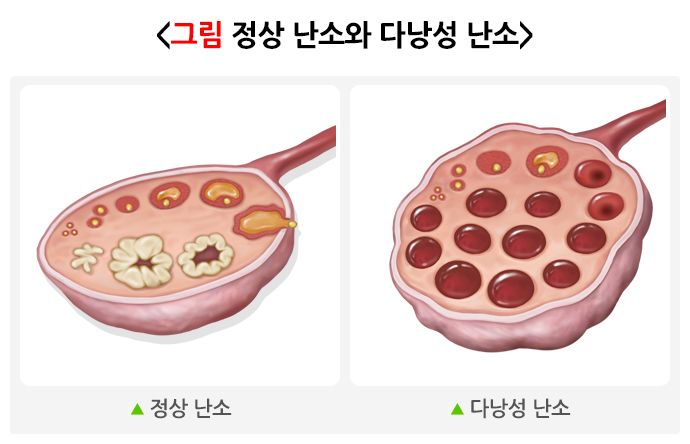 정상 난소와 다낭성 난소