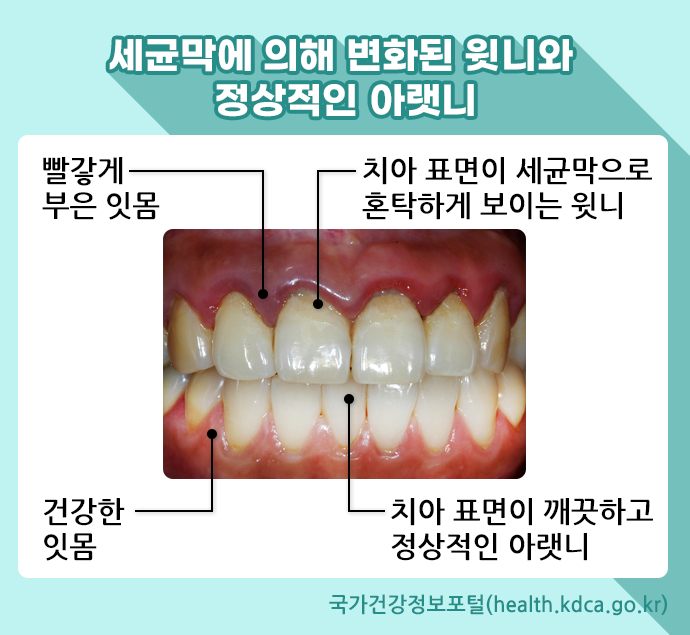 세균막에 의해 변화된 윗니와 정상적인 아랫니. 빨갛게 부은 잇몸. 치아 표면이 세균막으로 혼탁하게 보이는 윗니. 건강한 잇몸. 치아 표면이 깨끗하고 정상적인 아랫