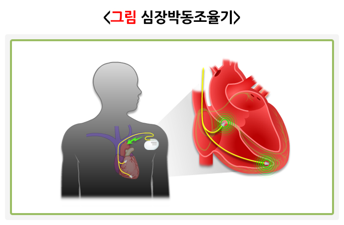 심장박동조율기