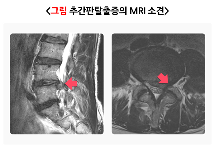 추간판탈출증의 MRI 소견