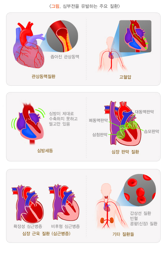 심부전을 유발하는 주요 질환