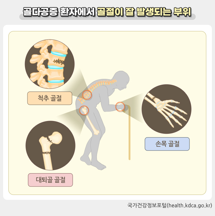 골다공증 환자에서 골절이 잘 발생되는 부위